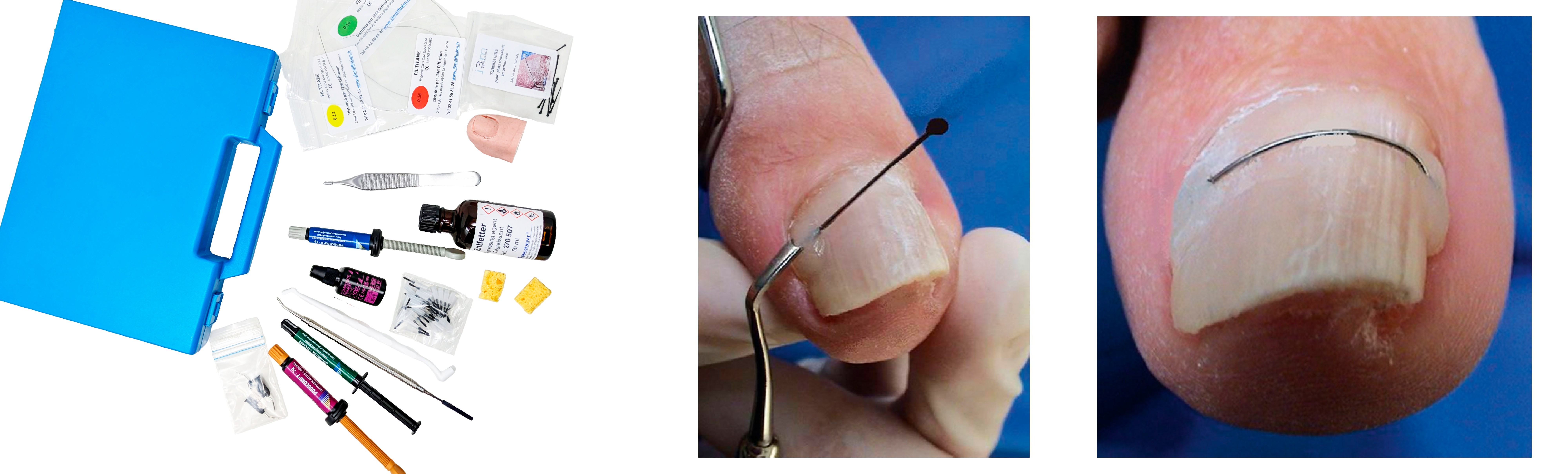 Ortonixia y siliconas - Podiatech